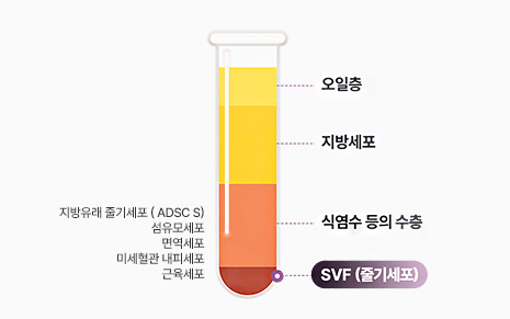 원심분리 후 튜브 안에서 오일층, 지방세포, 식염수 등의 수층, SVF(줄기세포) 순으로 나뉜 모습